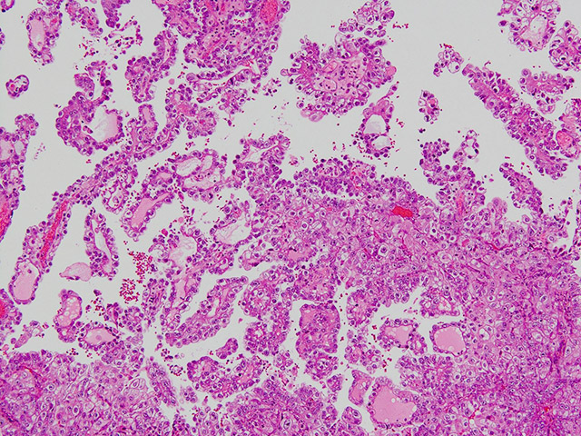 手術標本例:卵巣（Clear cell carcinoma）